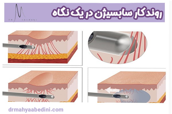 نحوه کار سابسیژن - دکتر محیا عابدینی