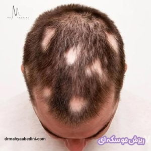 ریزش مو سکه ای - دکتر محیا عابدینی 