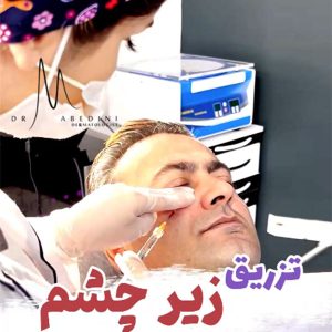 تزریق فیلر زیر چشم جهت رفع گودی و تیرگی زیر چشم توسط دکتر محیا عابدینی در تهران