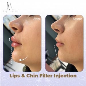 نمونه تزریق فیلر ترکیبی لب و چانه توسط دکتر محیا عابدینی برای فرم دهی طبیعی چهره در تهران