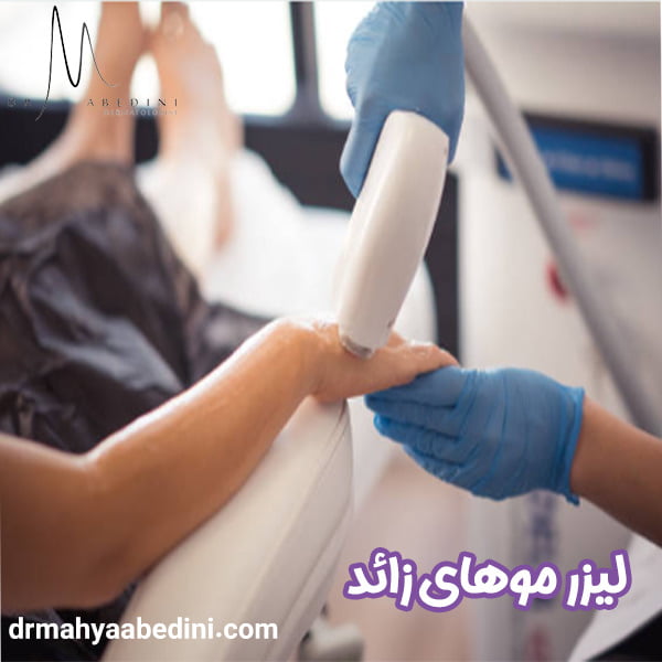 لیزر موهای زائد - دکتر محیا عابدینی