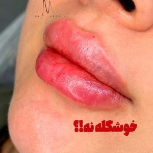 تزریق ژل 1 - دکتر محیا عابدینی 