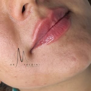 تزریق ژل 2 - دکتر محیا عابدینی 