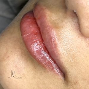 تزریق ژل 3 - دکتر محیا عابدینی 