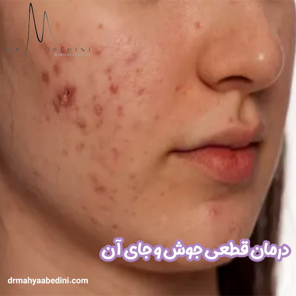 درمان قطعی جوش و جای آن - دکتر محیا عابدینی