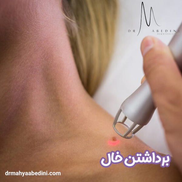 برداشتن خال - دکتر محیا عابدینی