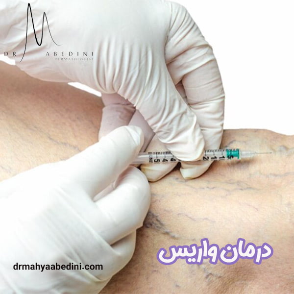 درمان واریس - دکتر محیا عابدینی