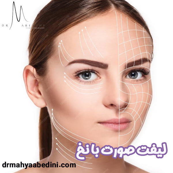 لیفت صورت با نخ - دکتر محیا عابدینی