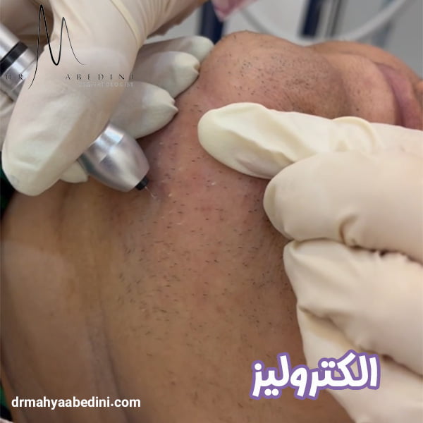 الکترولیز - دکتر محیا عابدینی