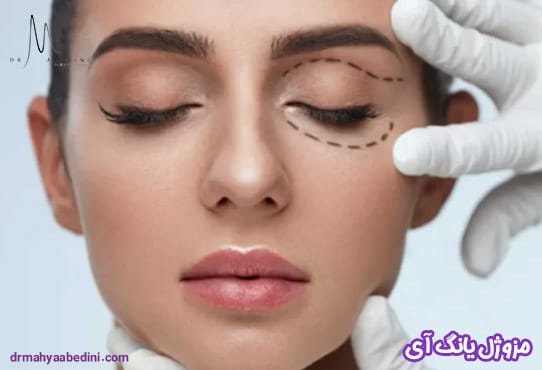 مزوژل یانگ آی