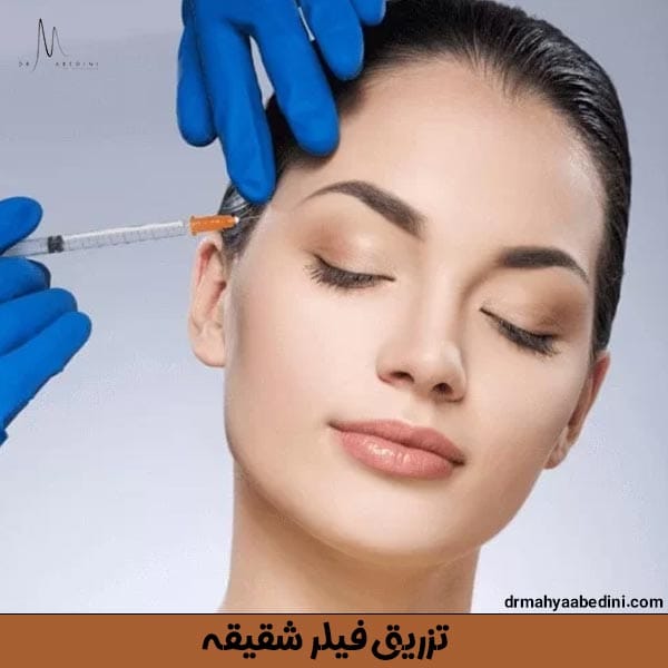 تزریق فیلر شقیقه