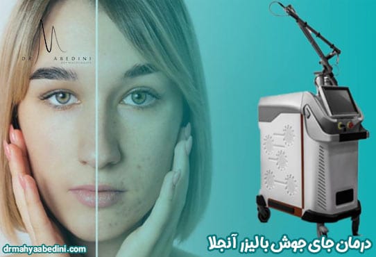 درمان جای جوش با لیزر آنجلا