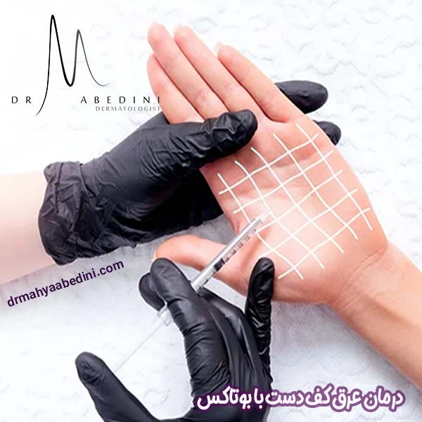 درمان عرق کف دست با بوتاکس