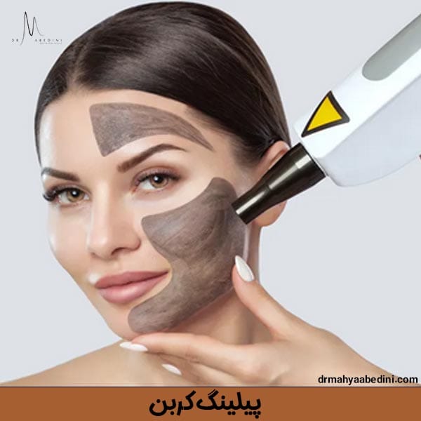 پیلینگ کربن